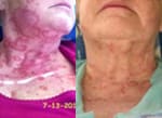 A before and after picture of an older woman 's neck.